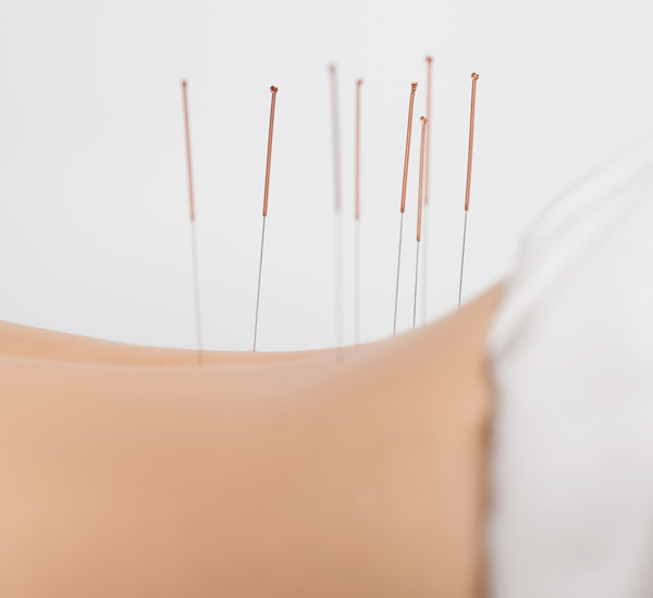 Er din akupunktør uddannet i akupunktur? artikel af Helle Wengel, Formand Skole- og Uddannelsesudvalget, Praktiserende Akupunktører